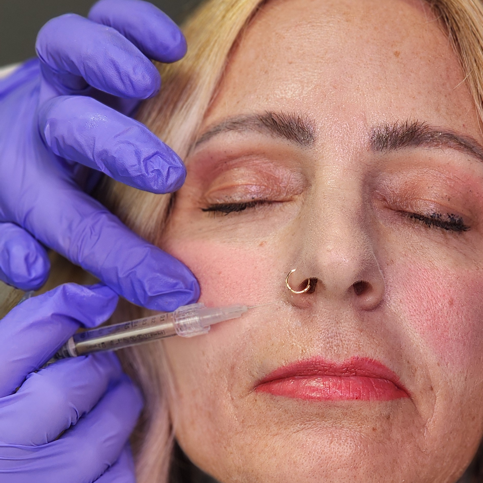 Flirt_Filler_Charlene1 botox fillers facials<br />